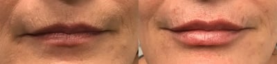 dermal filler before and after photo by bcrn aesthetics in houston tx