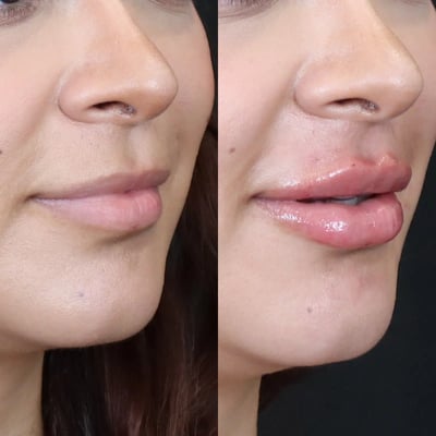dermal filler before and after photo by bcrn aesthetics in houston tx