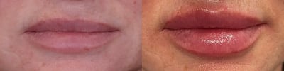 dermal filler before and after photo by bcrn aesthetics in houston tx