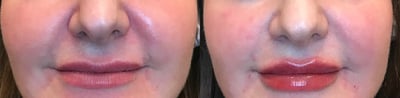 dermal filler before and after photo by bcrn aesthetics in houston tx
