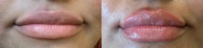 dermal filler before and after photo by bcrn aesthetics in houston tx