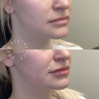 dermal filler before and after photo by bcrn aesthetics in houston tx