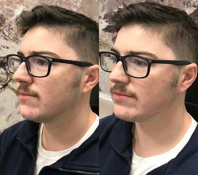 dermal filler before and after photo by bcrn aesthetics in houston tx