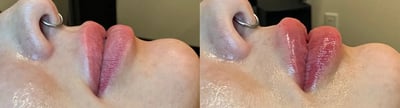 dermal filler before and after photo by bcrn aesthetics in houston tx