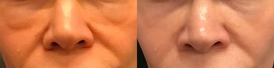 dermal filler before and after photo by bcrn aesthetics in houston tx