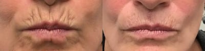 dermal filler before and after photo by bcrn aesthetics in houston tx