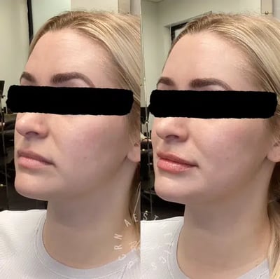dermal filler before and after photo by bcrn aesthetics in houston tx
