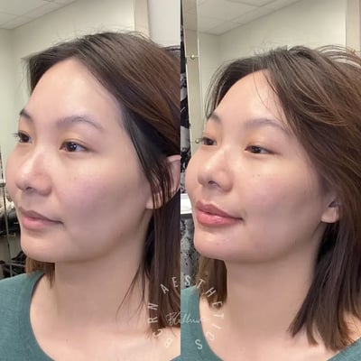 dermal filler before and after photo by bcrn aesthetics in houston tx