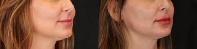 dermal filler before and after photo by bcrn aesthetics in houston tx