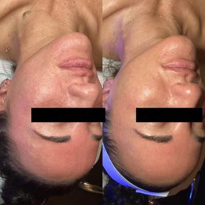 hydrafacial before and after photo by bcrn aesthetics in houston tx