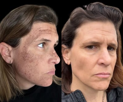 lumecca ipl before and after photo by bcrn aesthetics in houston tx