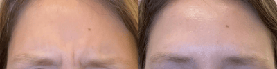 neuromodulators before and after photo by bcrn aesthetics in houston tx