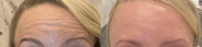 neuromodulators before and after photo by bcrn aesthetics in houston tx