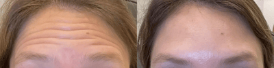 neuromodulators before and after photo by bcrn aesthetics in houston tx