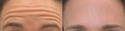 neuromodulators before and after photo by bcrn aesthetics in houston tx