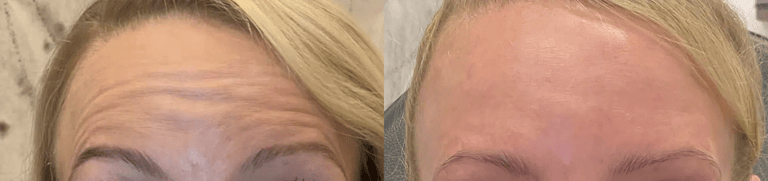 neuromodulators before and after photo by bcrn aesthetics in houston tx