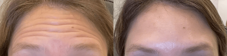 neuromodulators before and after photo by bcrn aesthetics in houston tx