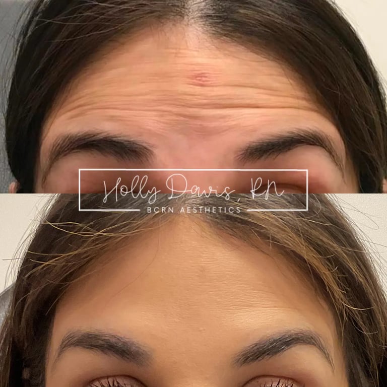 neuromodulators before and after photo by bcrn aesthetics in houston tx
