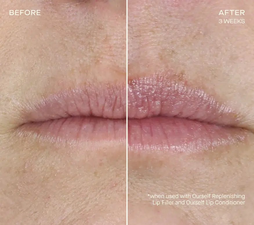 Ourself Before and Afters Lip . Subjet x bbea fc db b bbfd x crop center@x