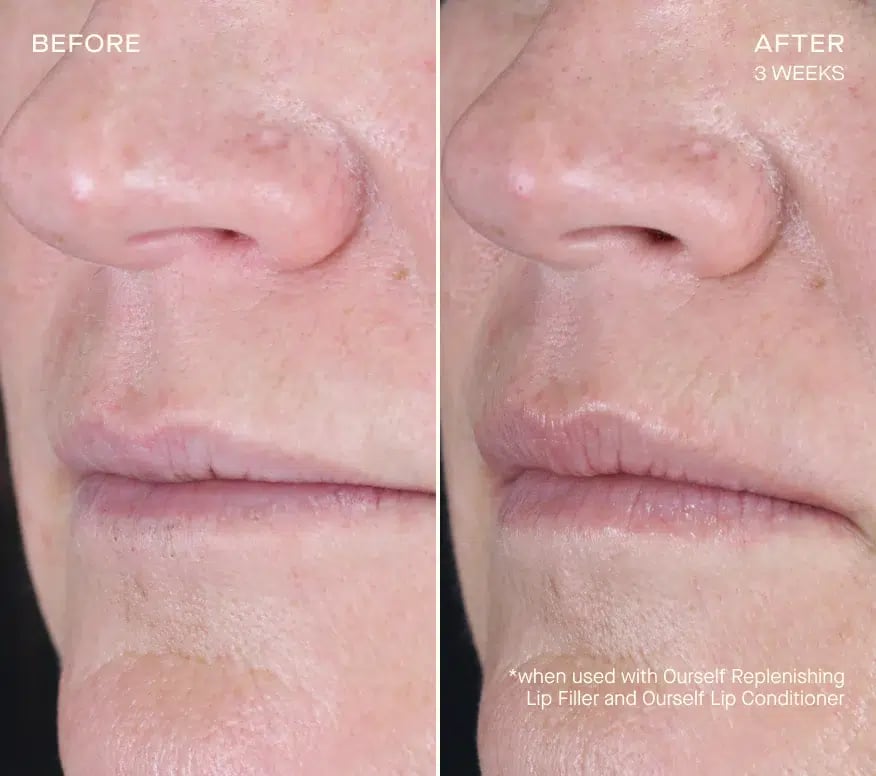 Ourself Before and Afters Lip . Subjet x V x crop center@x